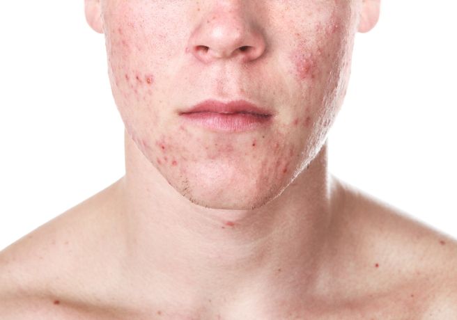 Derma Clear Solution 