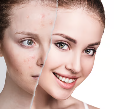  Acné Scar Repair 