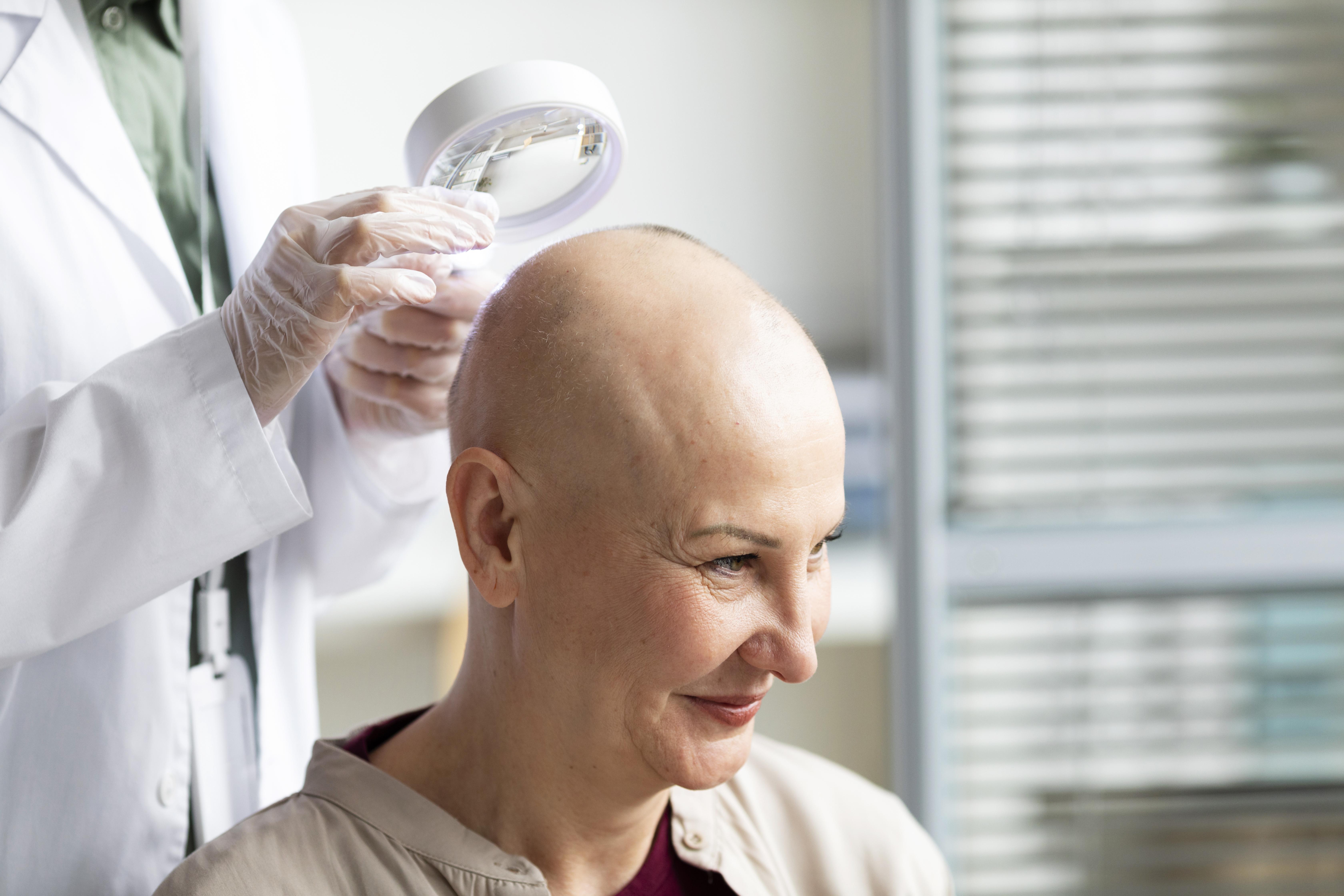  Tratamiento Alopecia hair V