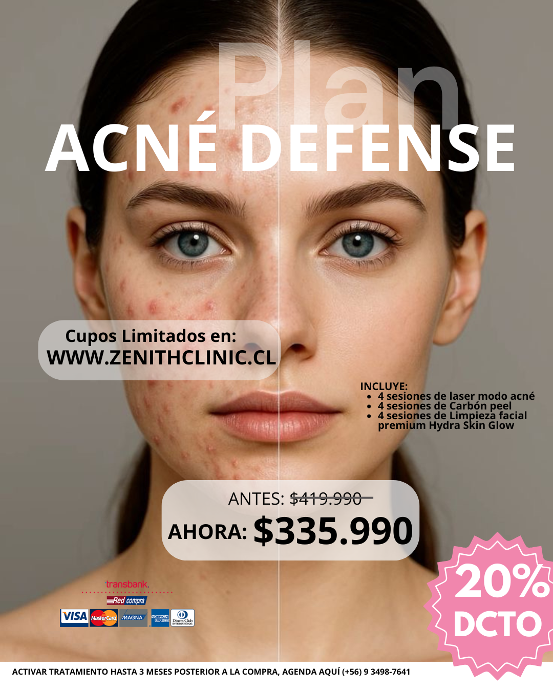 Plan Acné Defense 
