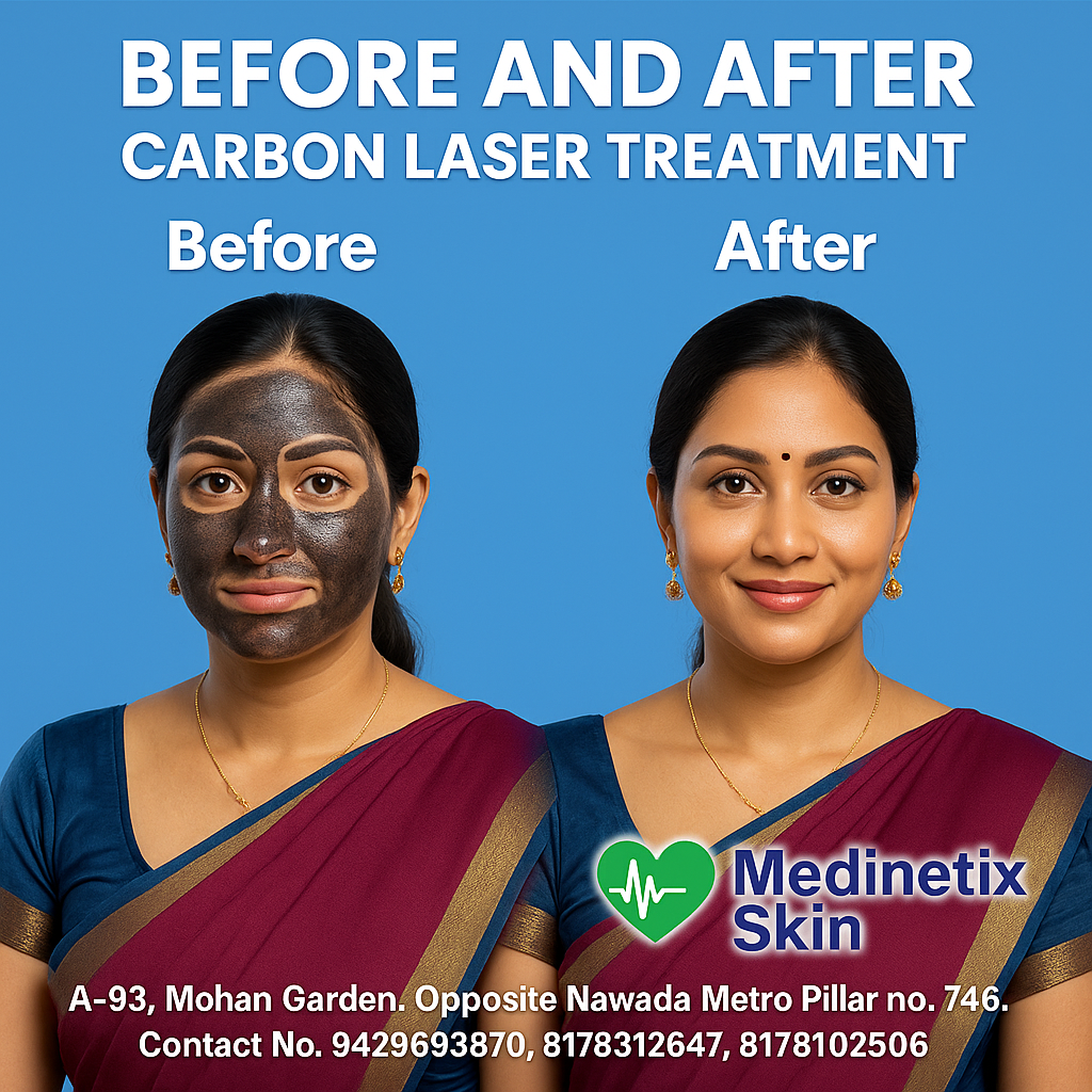 Carbon Laser treatment before and after