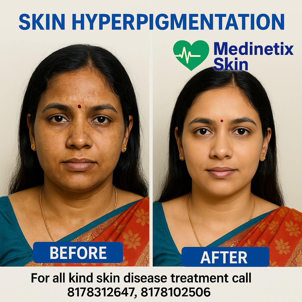 Melasma Treatment before and after