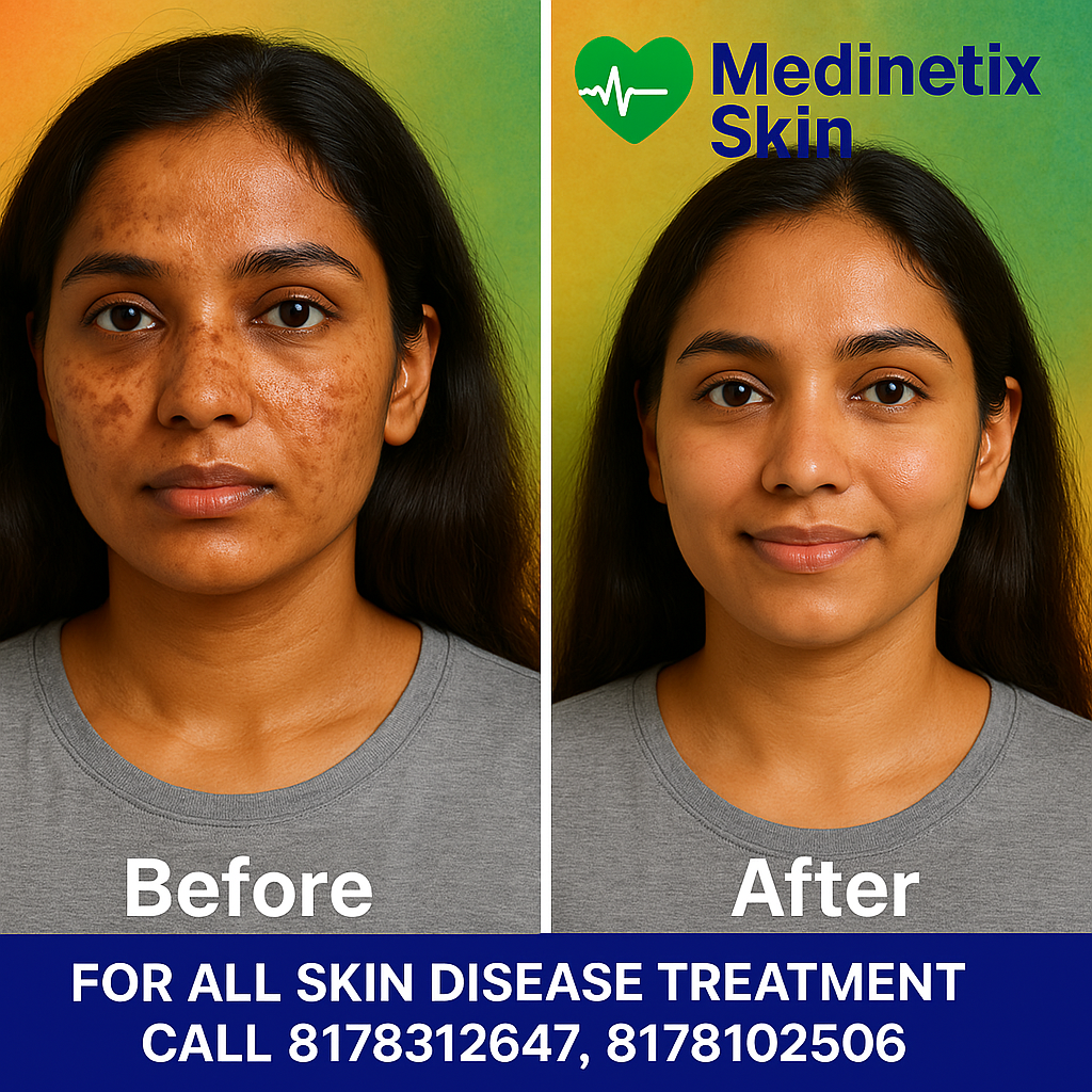 Acne Treatment before and after