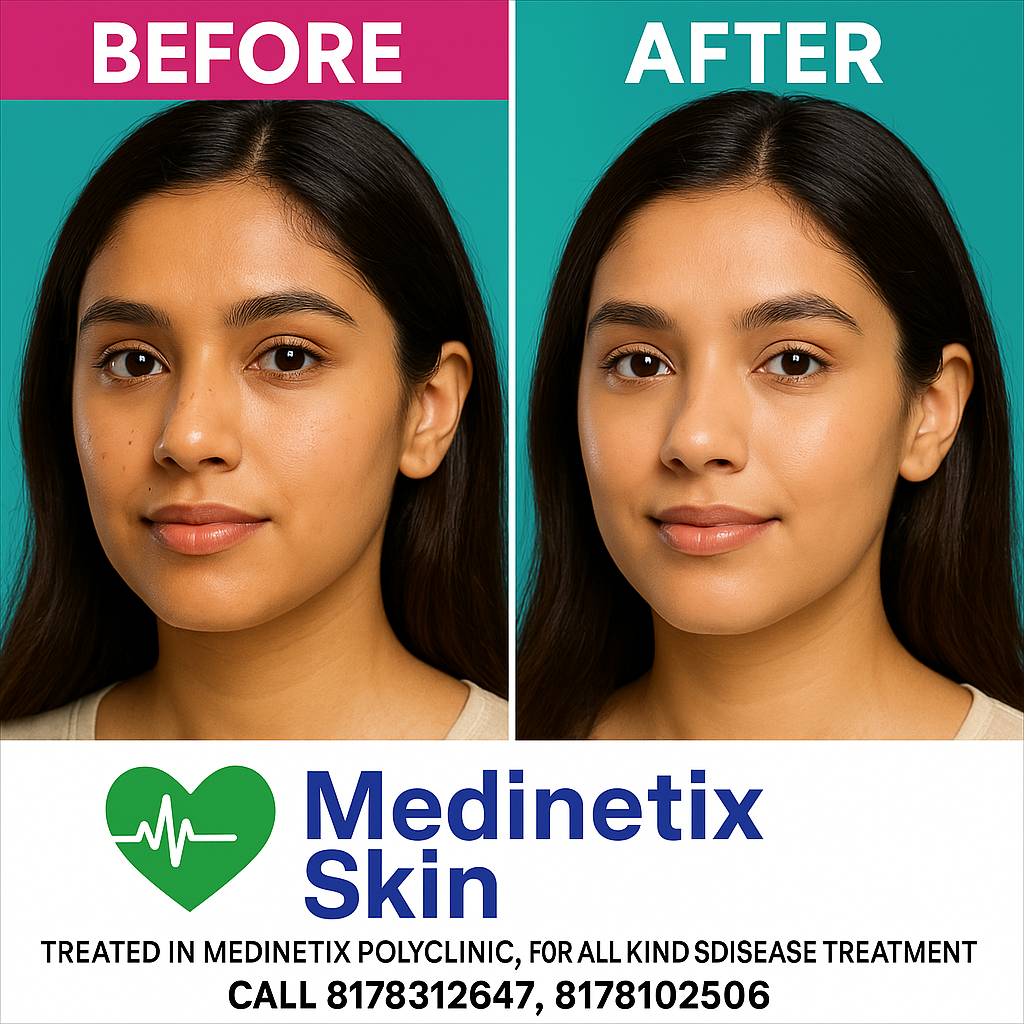 Acne Treatment before and after