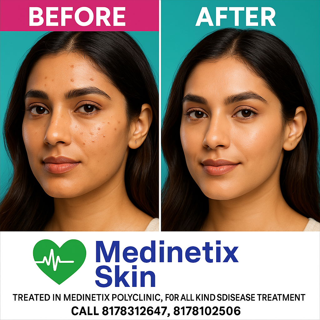 Acne Treatment before and after
