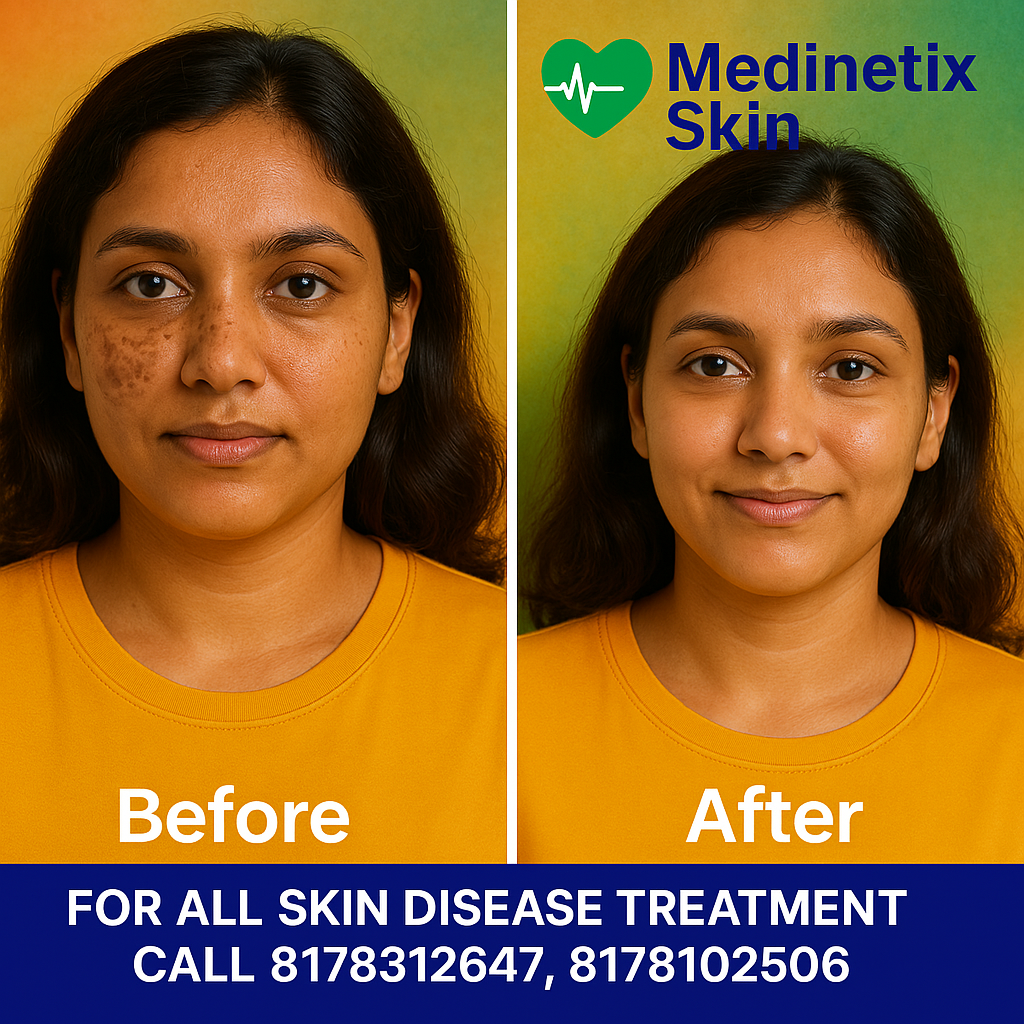 Acne Treatment before and after