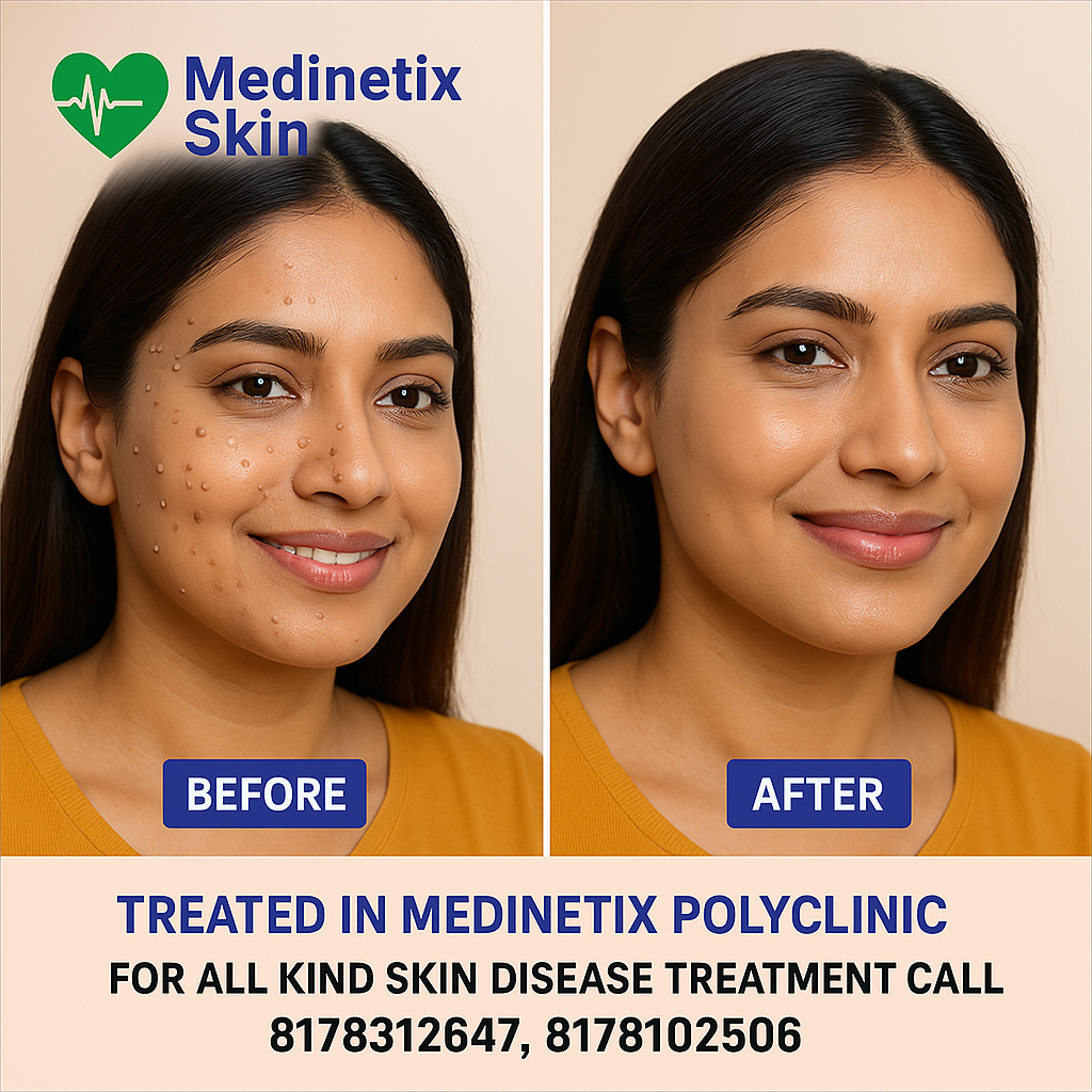 Mole treatment before and after