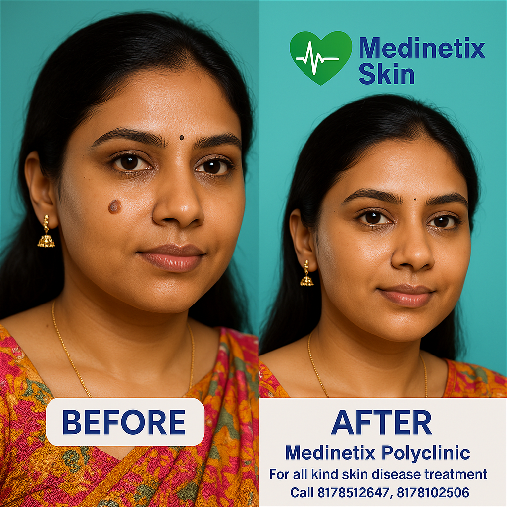Mole treatment before and after