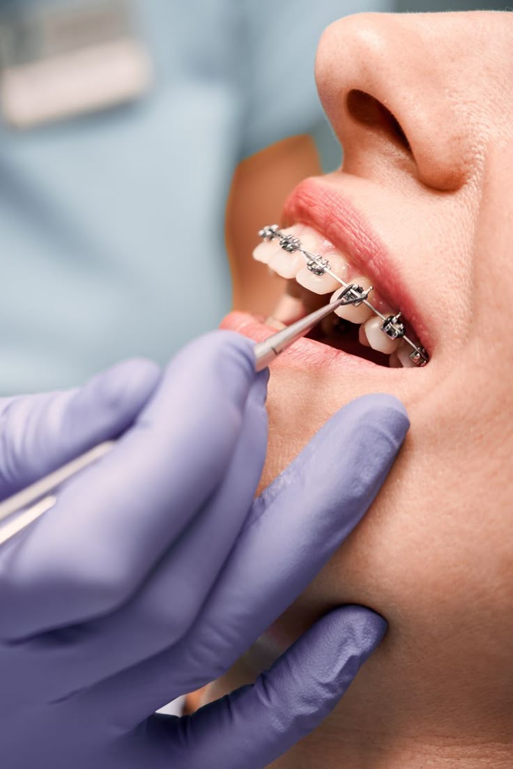 Dental Metal Braces
