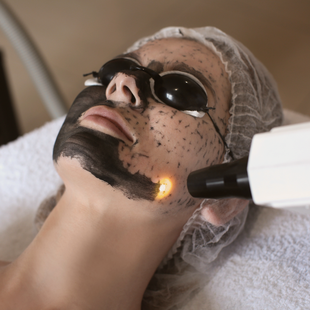Hollywood peel