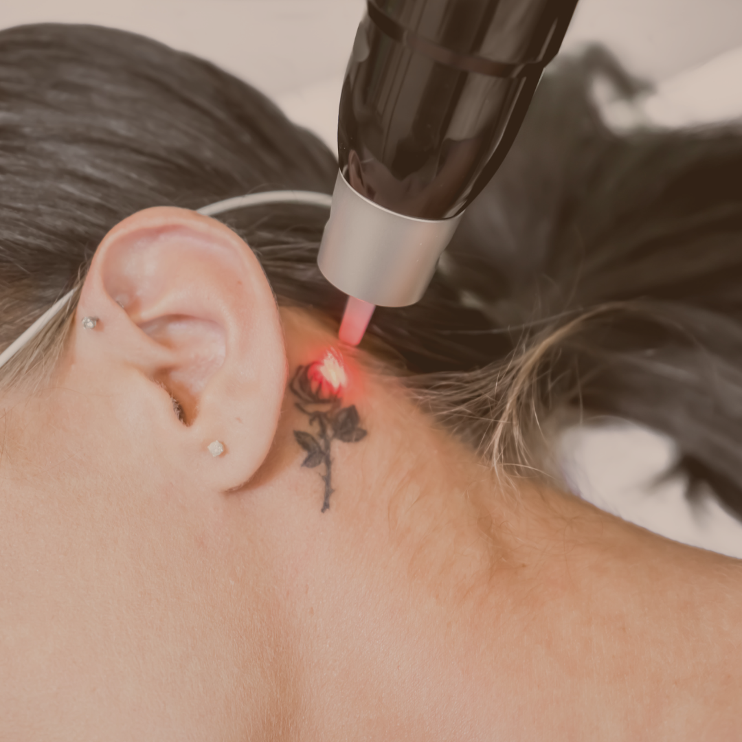 Retiro de tatuajes