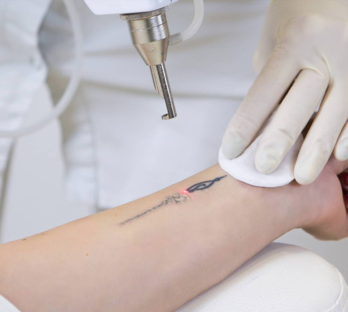 Eliminación de tatuajes (Grandes: 9 - 12 cm)