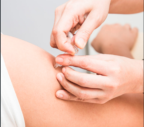 Carboxiterapia brazos