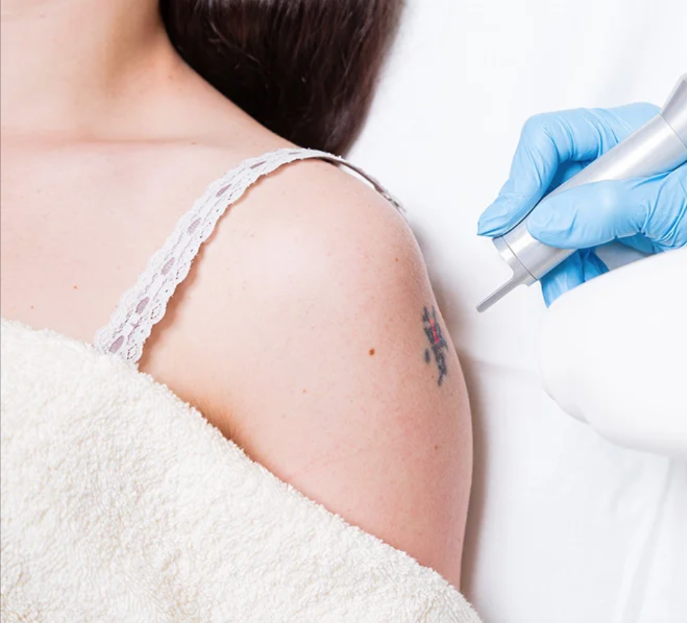 Eliminación de tatuajes (Medianos: 4 - 8 cm)