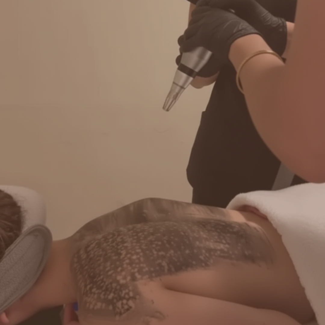 Hollywood peel espalda