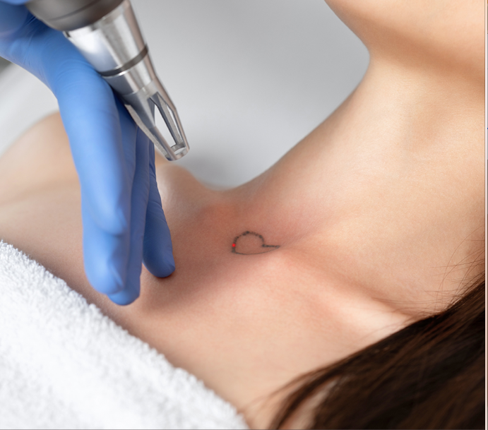Eliminación de tatuajes (Pequeños: 1 - 3 cm)