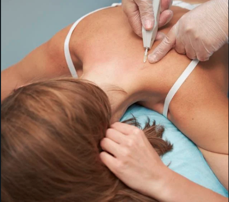 Carboxiterapia espalda