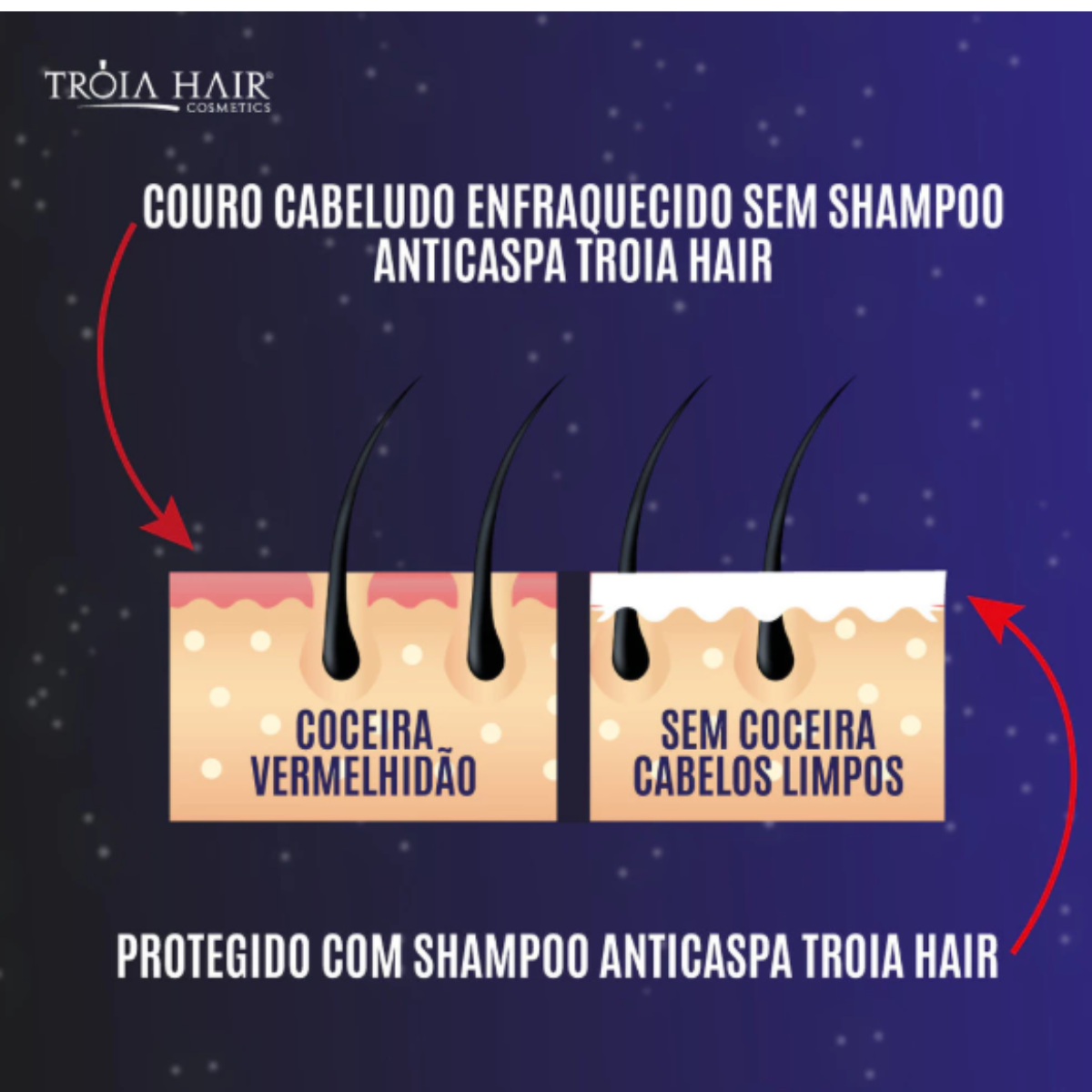 Shampoo Para Dermatite Seborreica Anticaspa 300ml