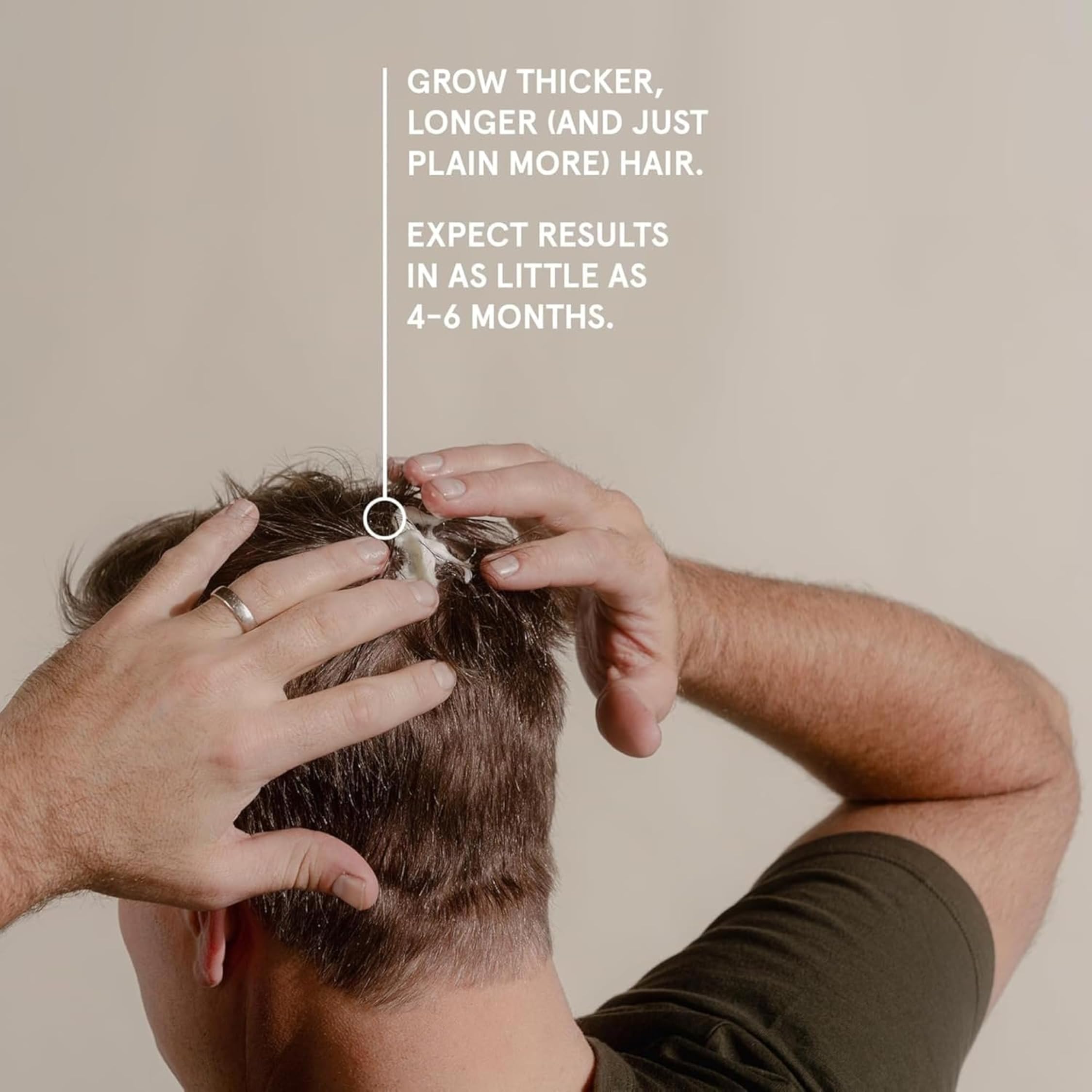 Keeps Extra Strength Minoxidil for Men Topical Aerosol Foam 5%, Hair Growth Treatment - 3 Month Supply (3 x 2.11oz Bottles)  Slows Hair Loss & Promotes Hair Regrowth