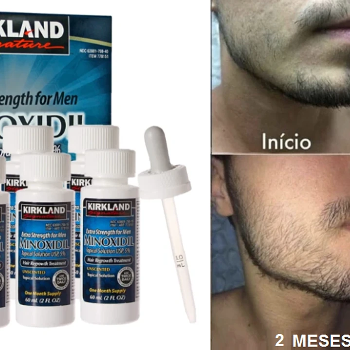  Minoxidil Kirkland al 5%