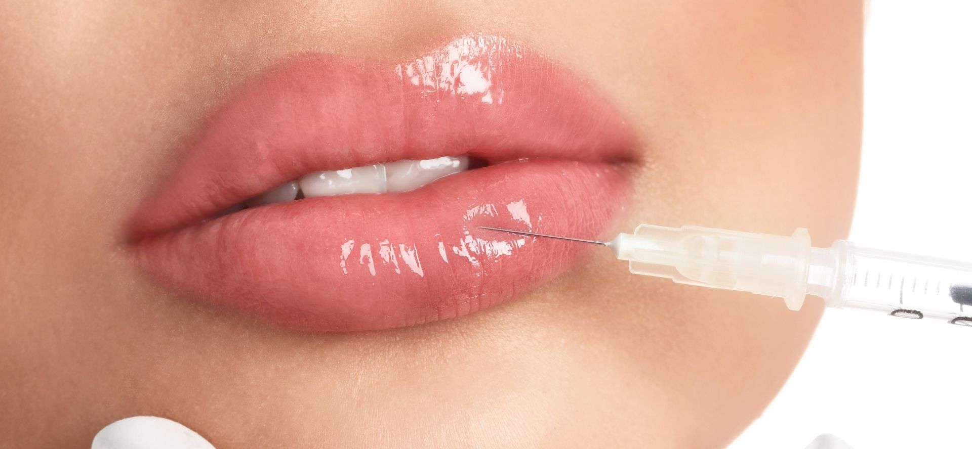 LipRefine® lip augmentation with hyaluronic acid