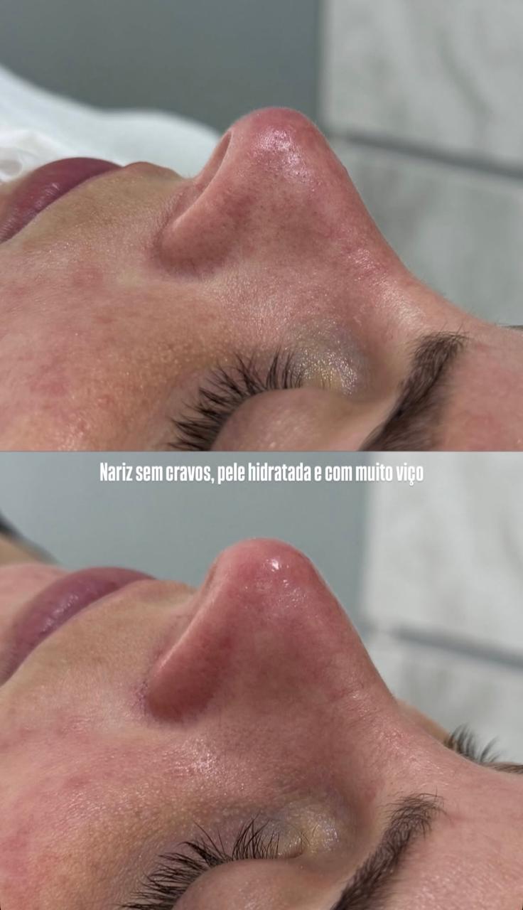 Limpeza de Pele Avançada + Consultoria Skin Care + Reavaliação após 15 dias