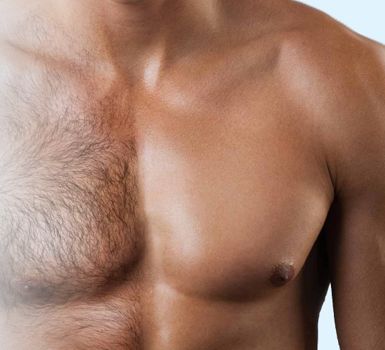 Soprano Laser - Full Beard