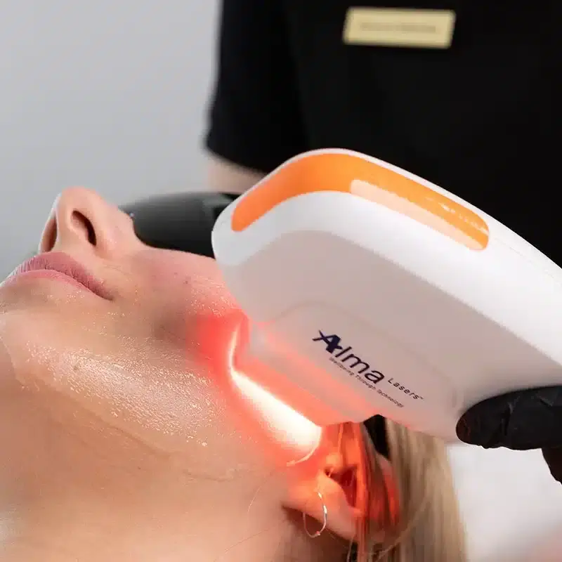 Soprano NIR Laser - Lower Face and Neck