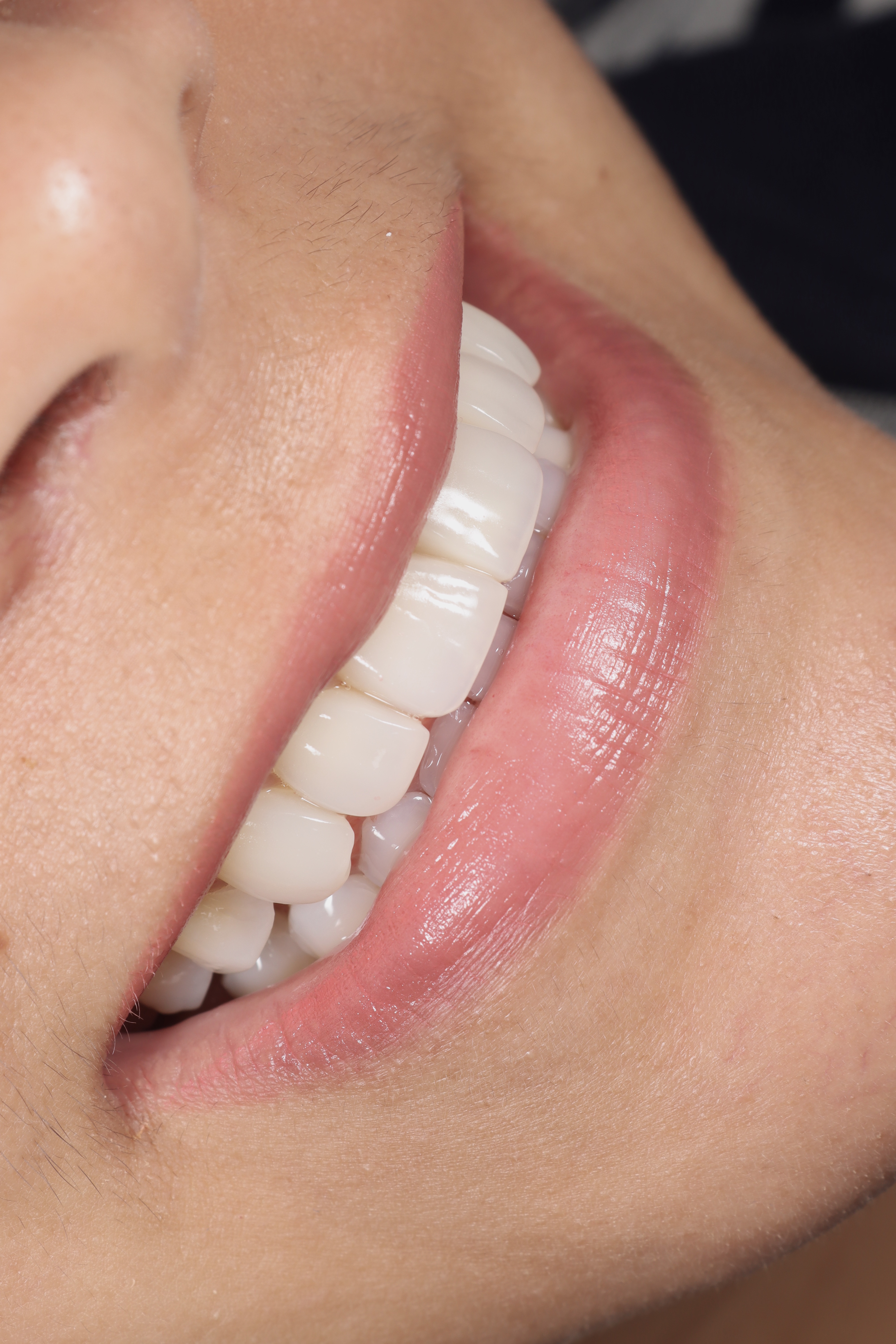 Blanqueamiento Dental