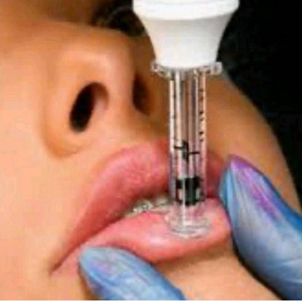 Hyaluron-Pen inkl. 10 Tube