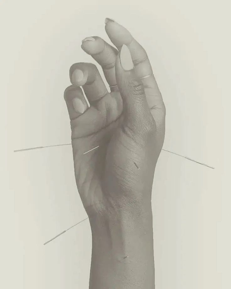 3 SESSIONS OF ACUPUNCTURE - ST LEONARD'S