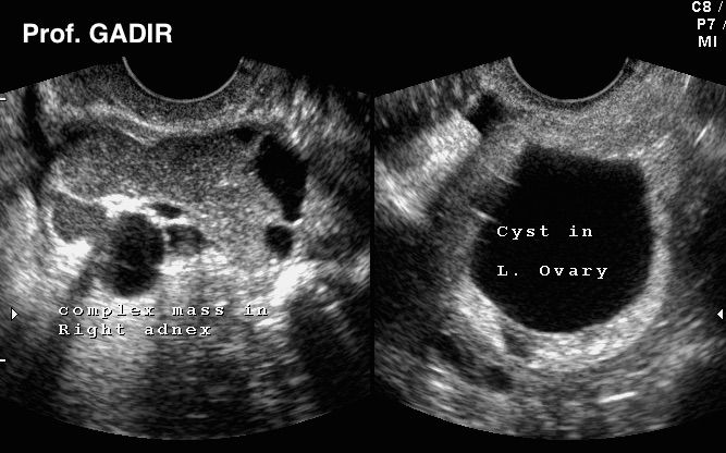 Ovarian Cyst Ultrasound