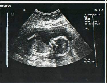 Dating Scan