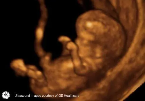 3 x Early Pregnancy Reassurance, Viability Baby Scans
