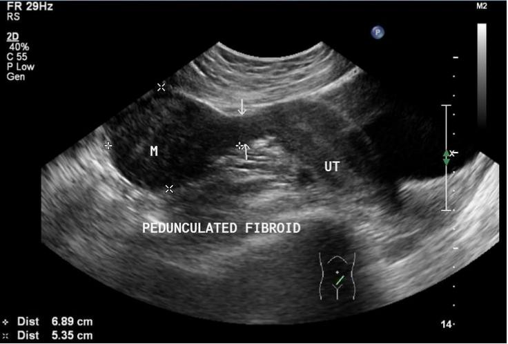 Fibroid Scan