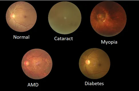 Eye Detection using Machine learning