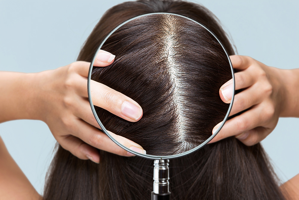 Scalp Hair Loss Treatment 