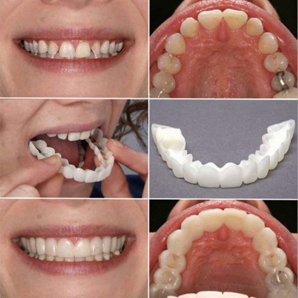 Snap On Smile Dentures
