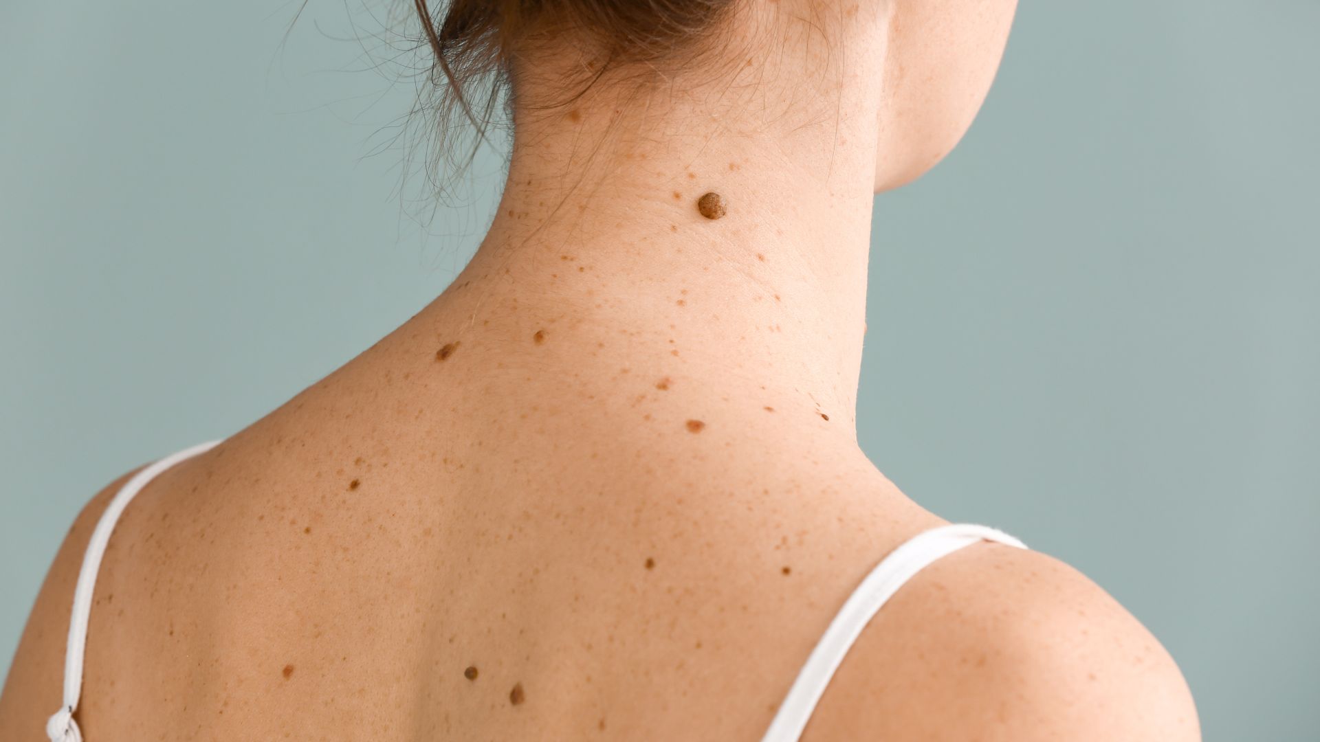 Precision Skin Lesion & Blemish Removal