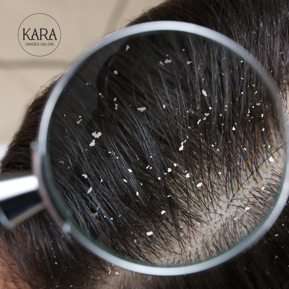 Dandruff Control Treatment