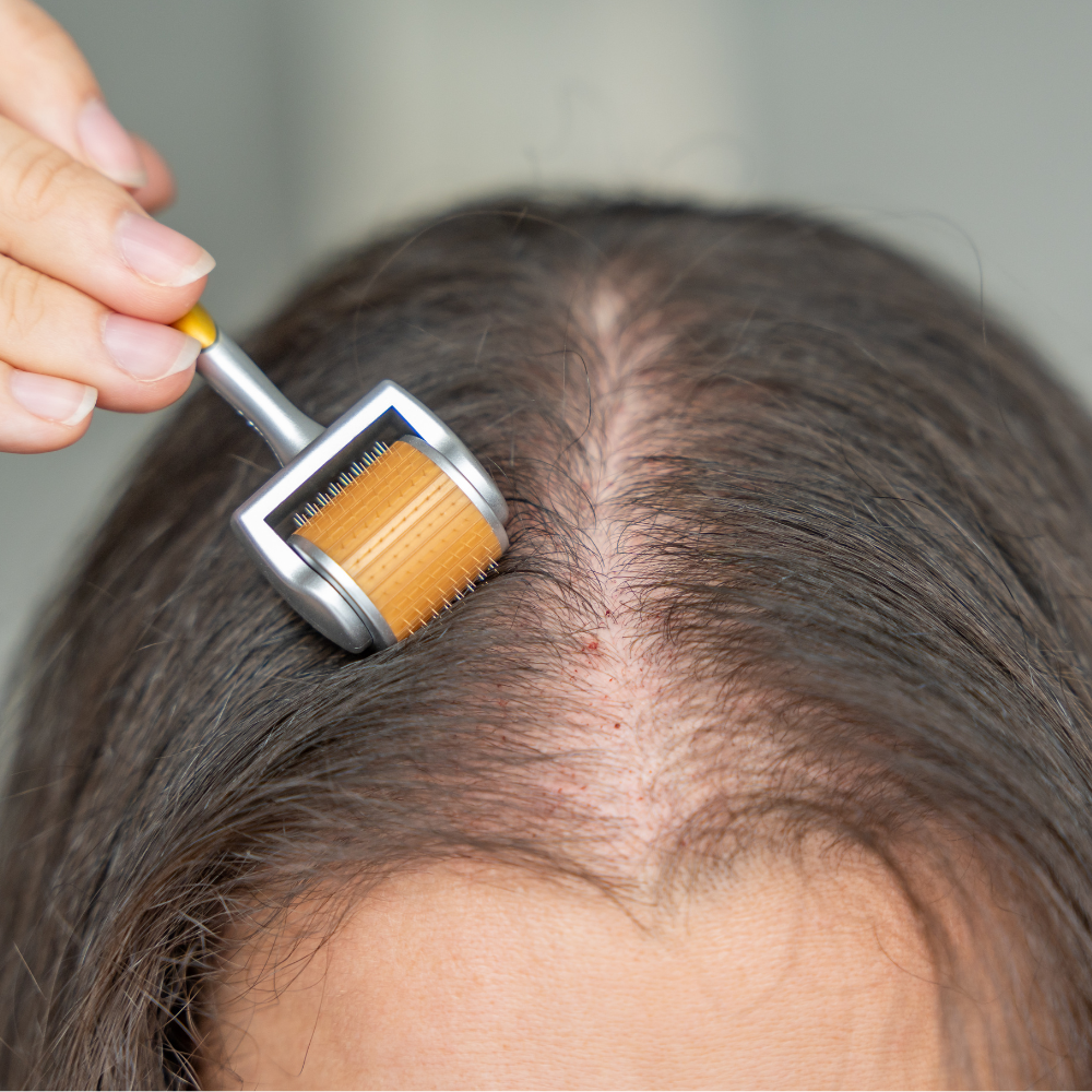 Micro Needling Hair Treatment