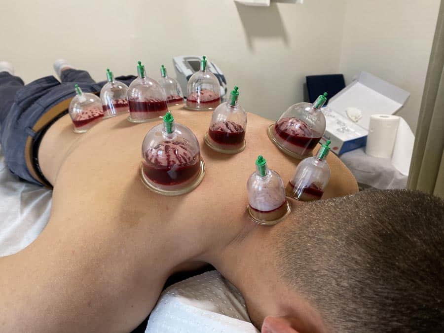 CUPPING / HIJAMA - GOLD PACKAGE