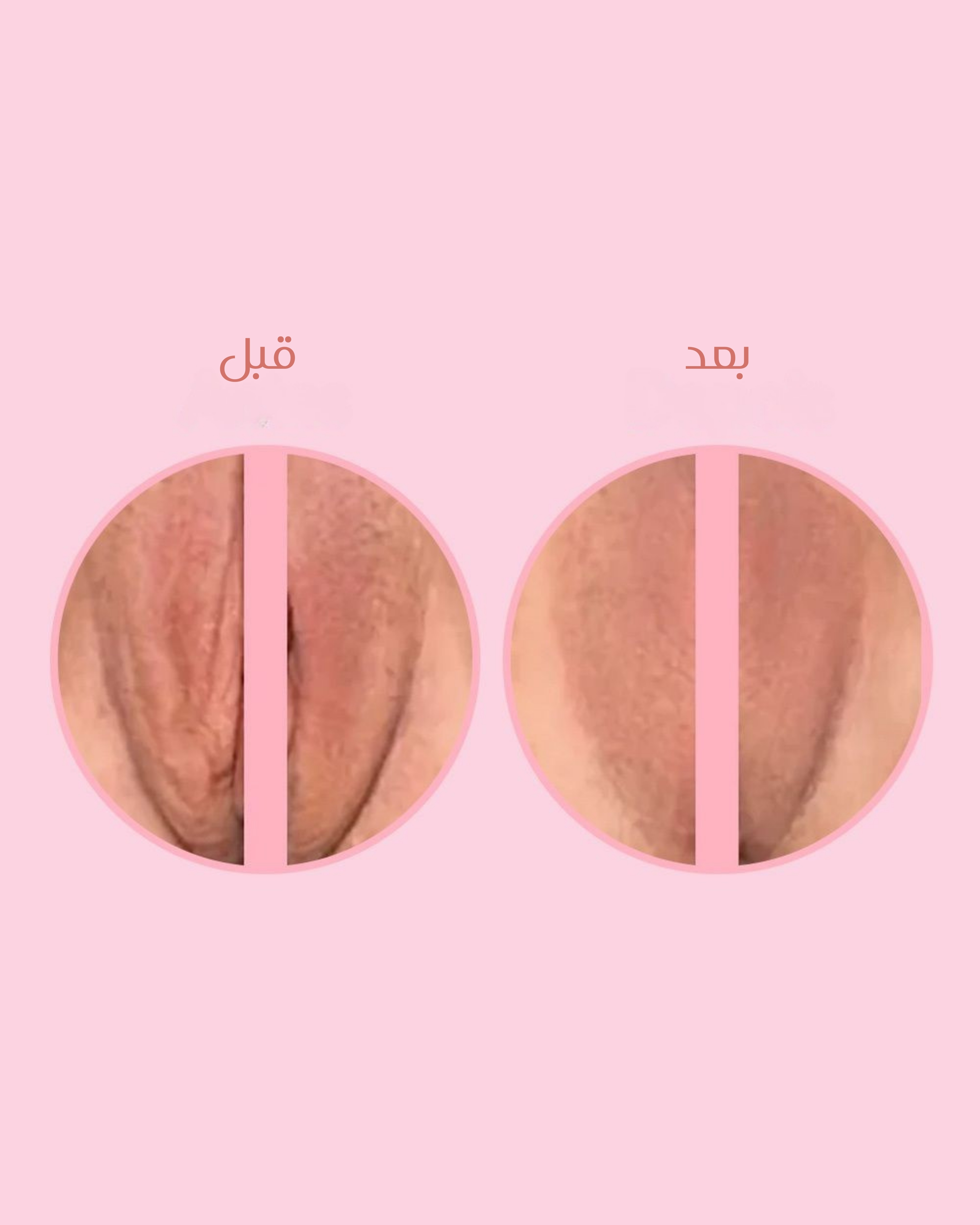  سيرم بديل بوتوكس للمناطق الانثوية