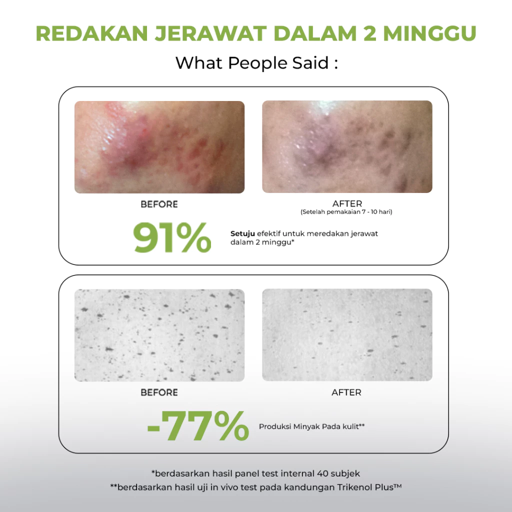 Facetology Triple Care Acne Calm Moisturizer 35 gr