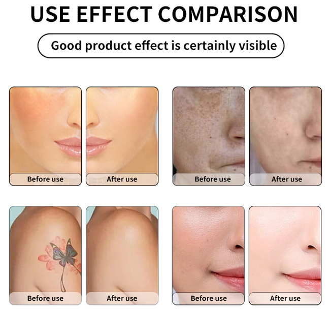 Scar Treatment by Pico Laser Beauty Equipments