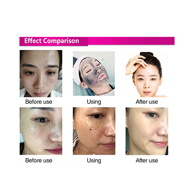 Picolaser 532nm 1064nm Laser All Color Pigment Removal Picosecond Laser Freckle Removal 