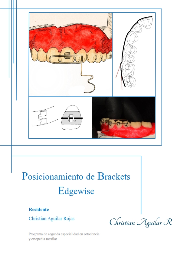 Posicionamiento de Brackets Edgewise
