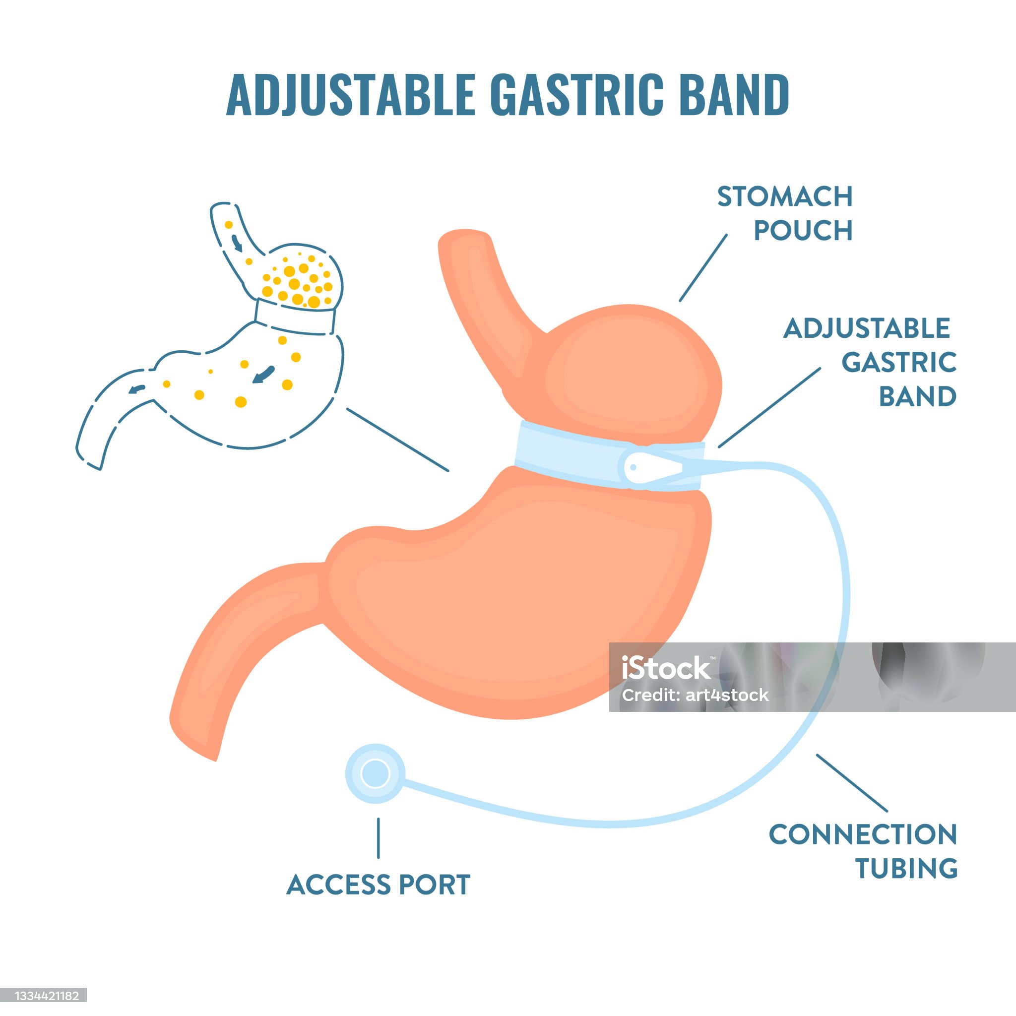 Hypno Gastric band