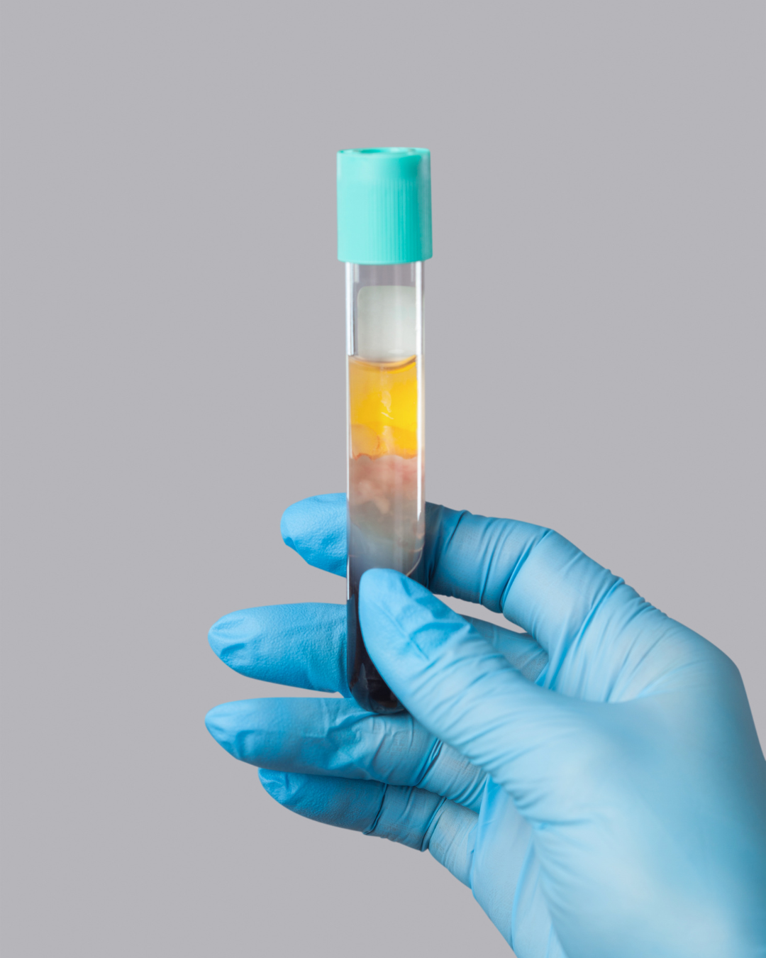 Plasma Rico en Plaquetas | PRP 3 sesiones