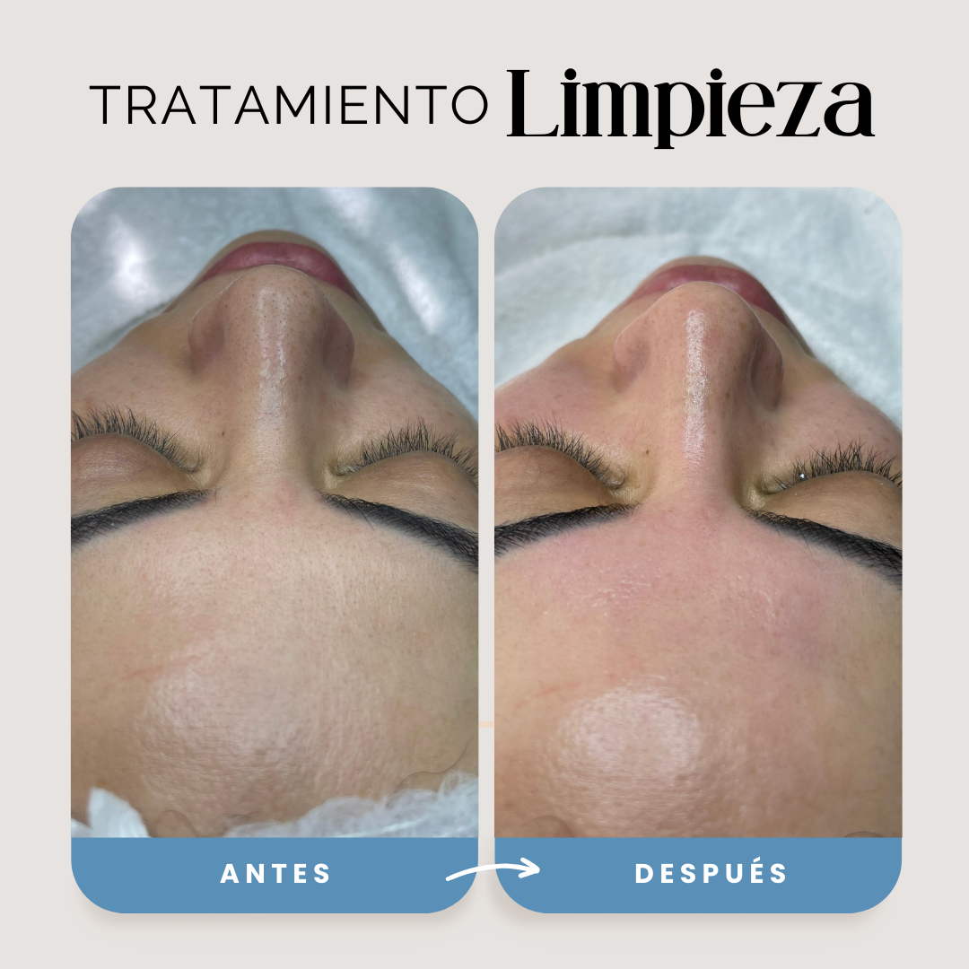 Limpieza Facial Profunda 